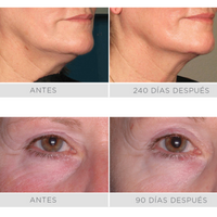 Ultherapy - Rostro Completo 850 lÍneas