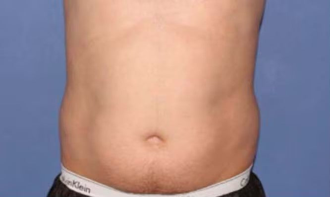 Antes de CoolSculpting