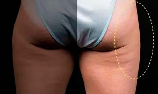 Después de CoolSculpting