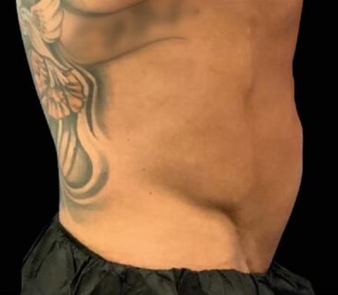 Antes de Emsculpt Neo