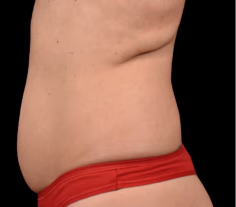 Antes de Emsculpt Neo