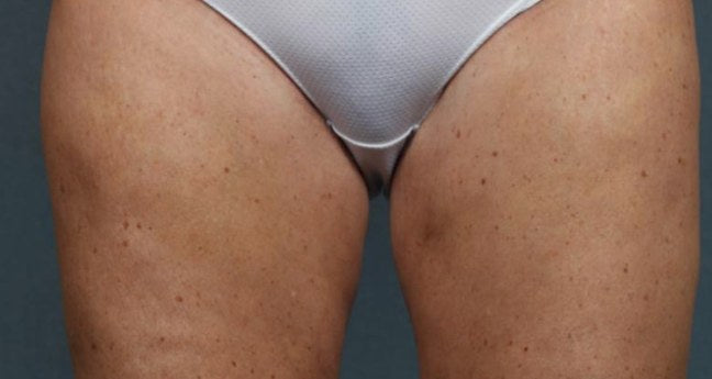 Después de mesoterapia corporal