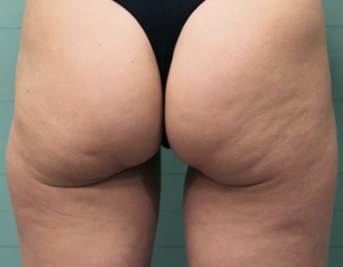 Antes de mesoterapia corporal