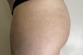 Después de mesoterapia corporal