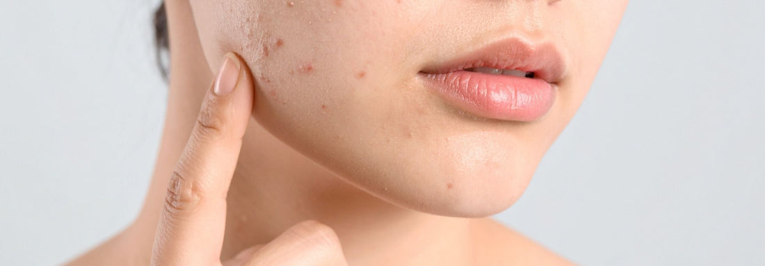 El estrés también afecta tu piel