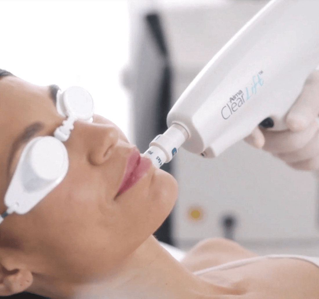 Clear Lift: qué es, cómo se siente y para quién está indicado - Ro Medical