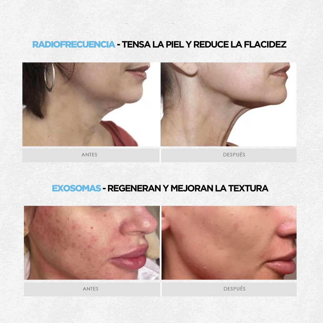 Facial Glow: Radiofrecuencia & Exosomas