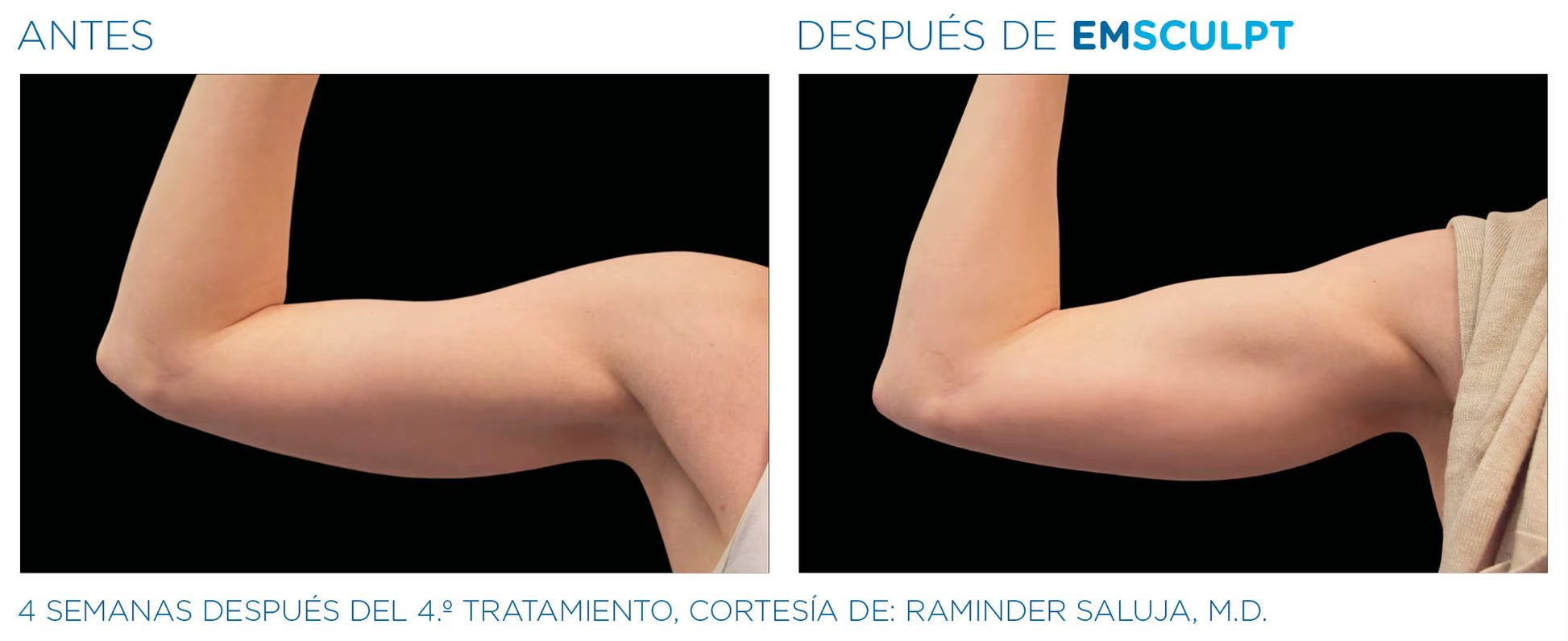 Emsculpt - Pack 6 Sesiones