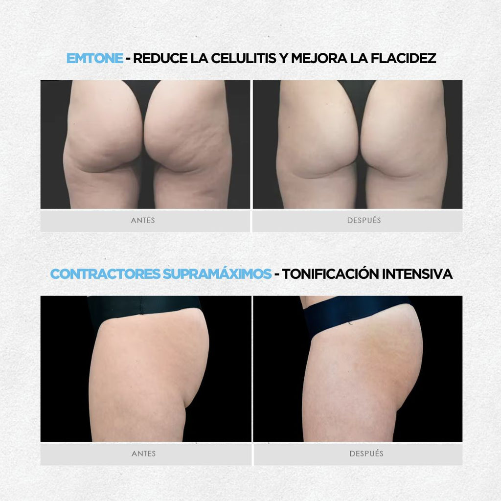 Plan Verano: Anticelulitis & Tonificación