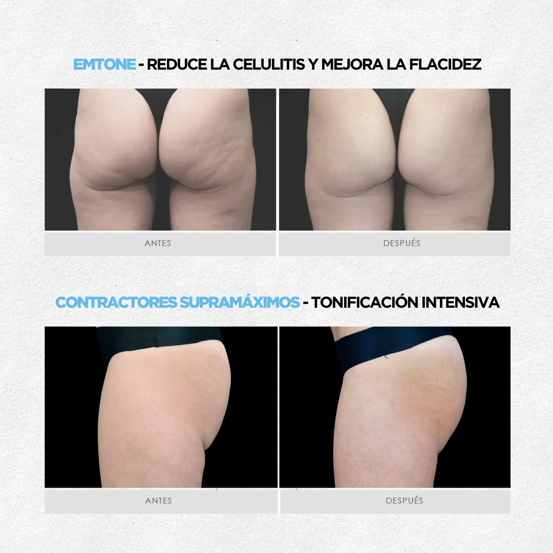 Plan Verano: Anticelulitis & Tonificación