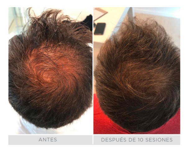 Mesoterapia española RRS XL HAIR (Tratamiento completo - 6 sesiones)
