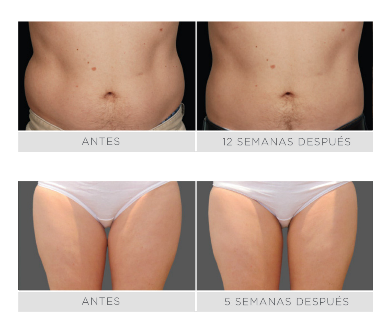 CoolSculpting - 1 ciclo CoolAdvantage