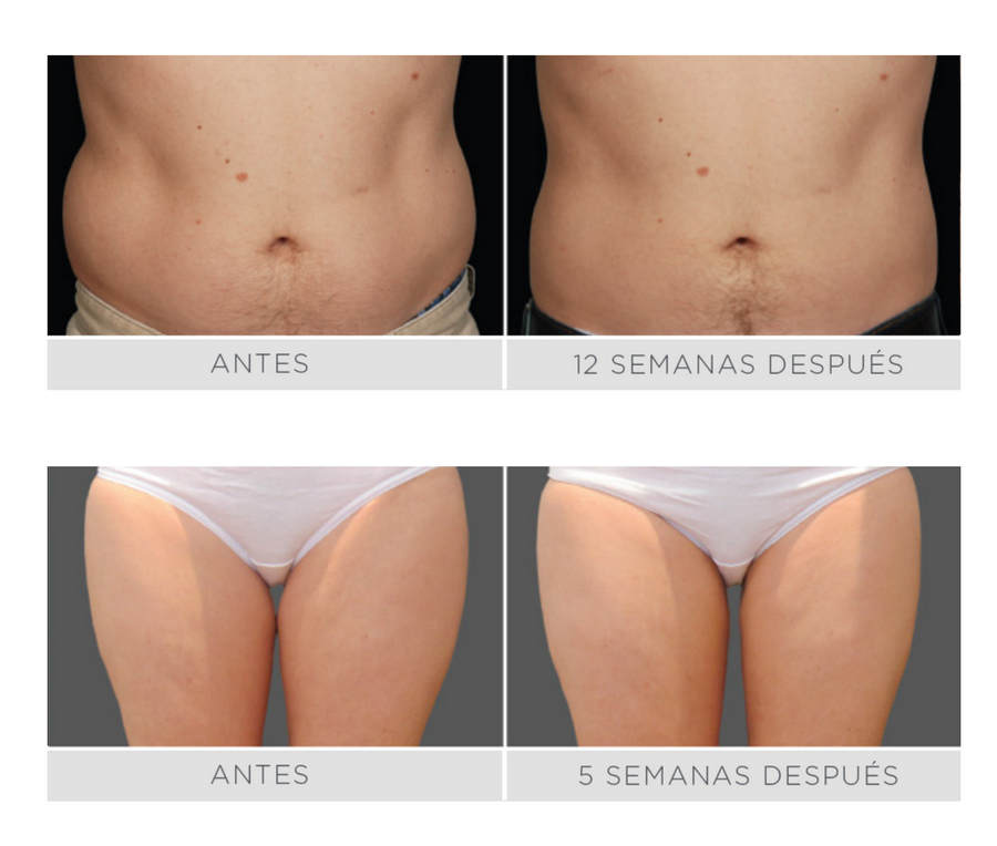 CoolSculpting - 1 Ciclo CoolSmooth