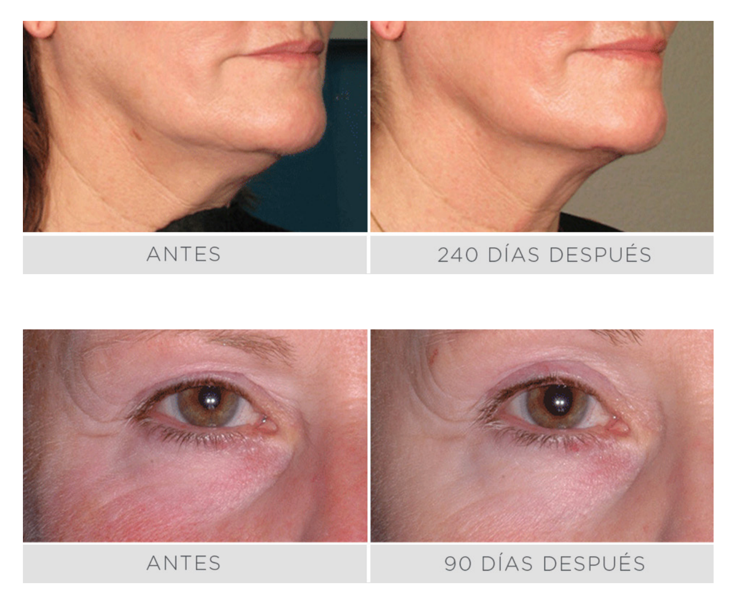 Ultherapy - Lifting sin cirugía - Rostro Completo 800 lÍneas