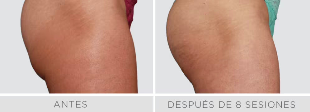 Radiofrecuencia Accent/Venus Legacy - Reduce la flacidez