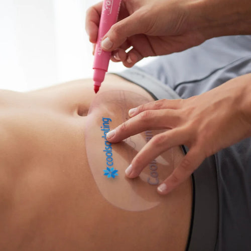 CoolSculpting - Adiposidad Localizada - 1 Ciclo CoolAdvantage Plus