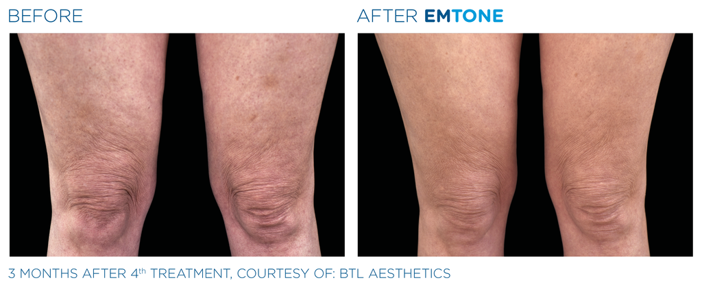 Emtone - Tratamiento para la celulitis