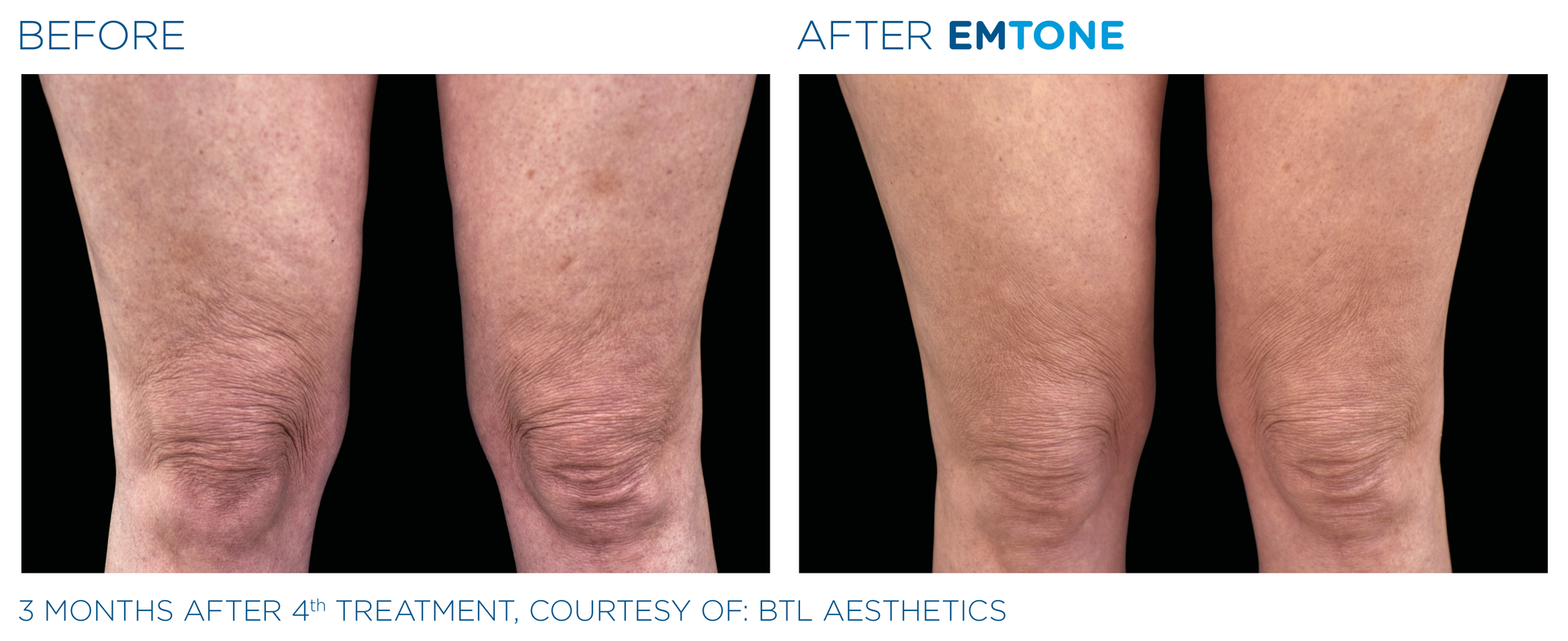 Emtone - Tratamiento para la celulitis