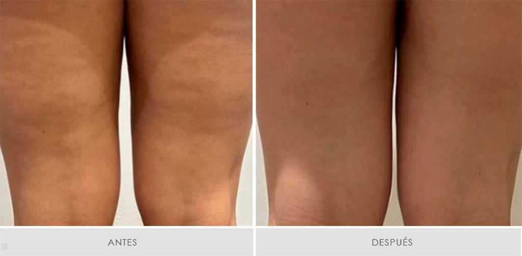 Mesoterapia Alidya - Pack de 6 sesiones