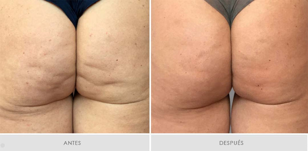 Mesoterapia Alidya - Pack de 6 sesiones