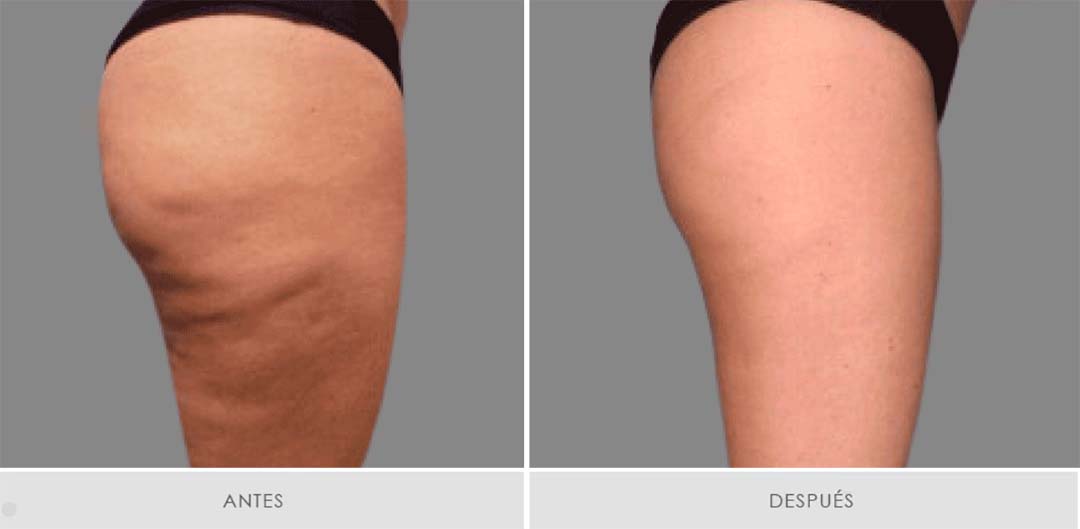 Mesoterapia Alidya - Pack de 6 sesiones