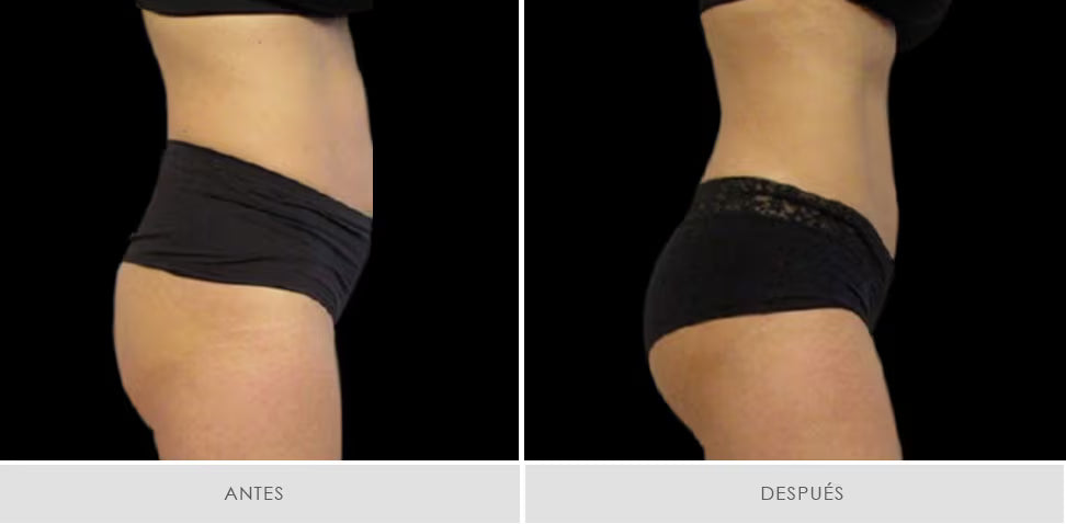 Emsculpt Neo - Pack 6 sesiones