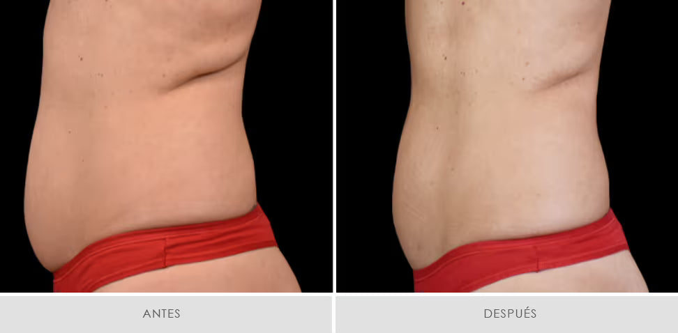 Emsculpt Neo - Pack 6 sesiones