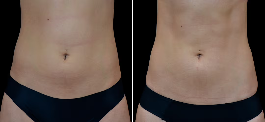 Contractores Supramáximos