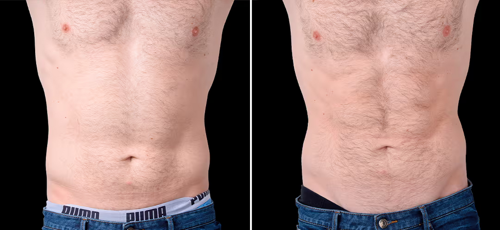 Contractores Supramáximos