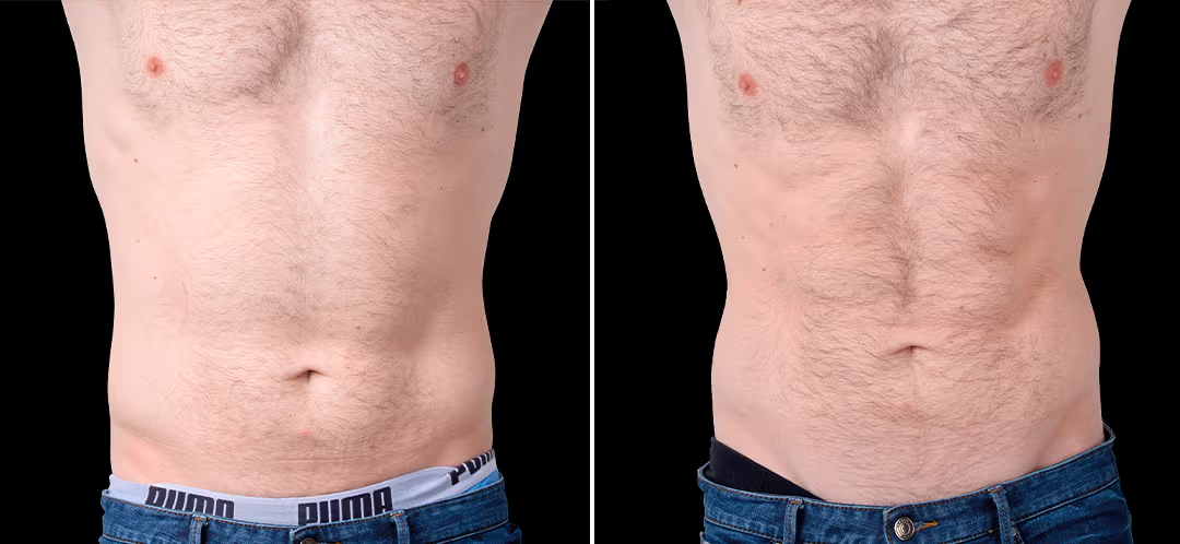 Contractores Supramáximos