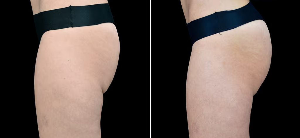 Contractores Supramáximos