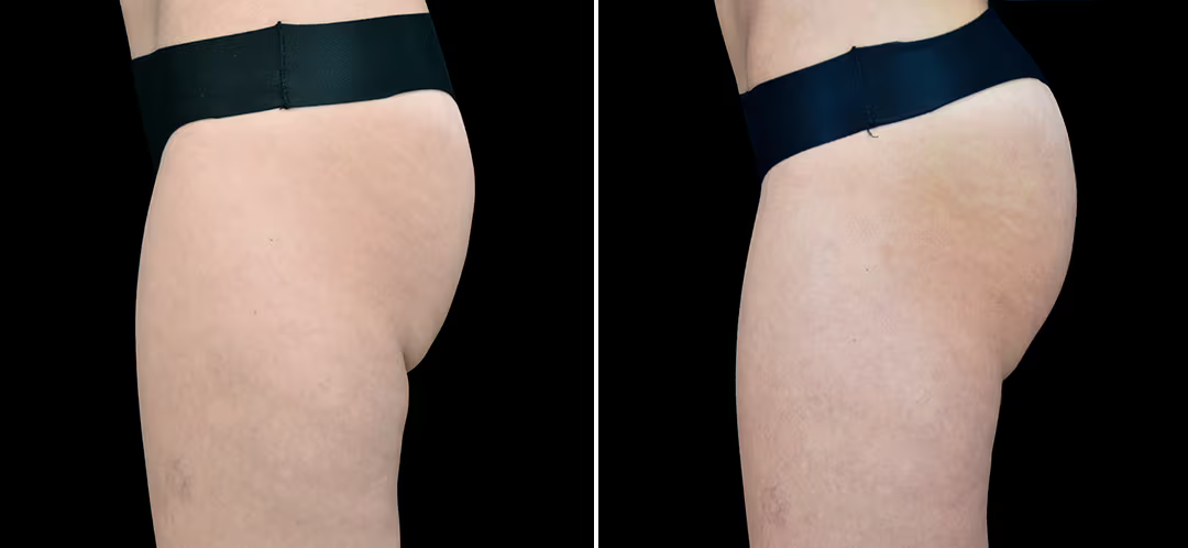 Contractores Supramáximos