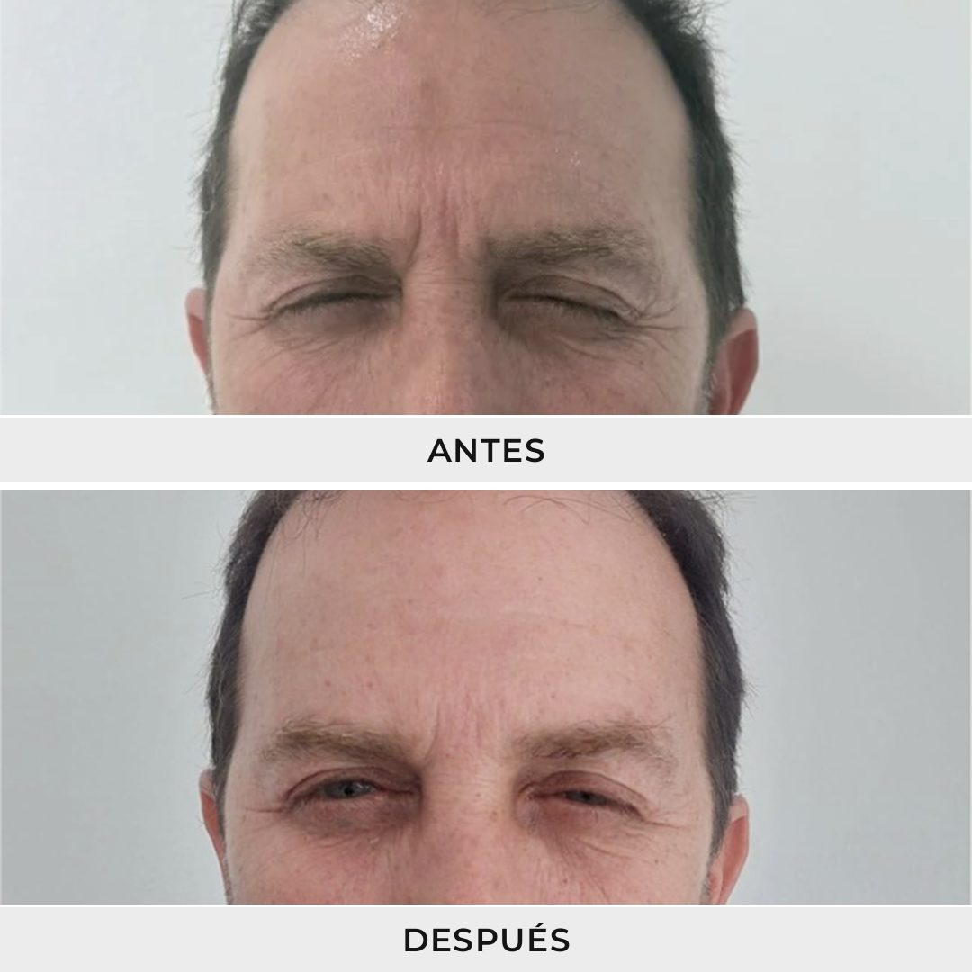 Aplicación de Neuromoduladores - Dra. Rolandi Ortíz - Ro Medical