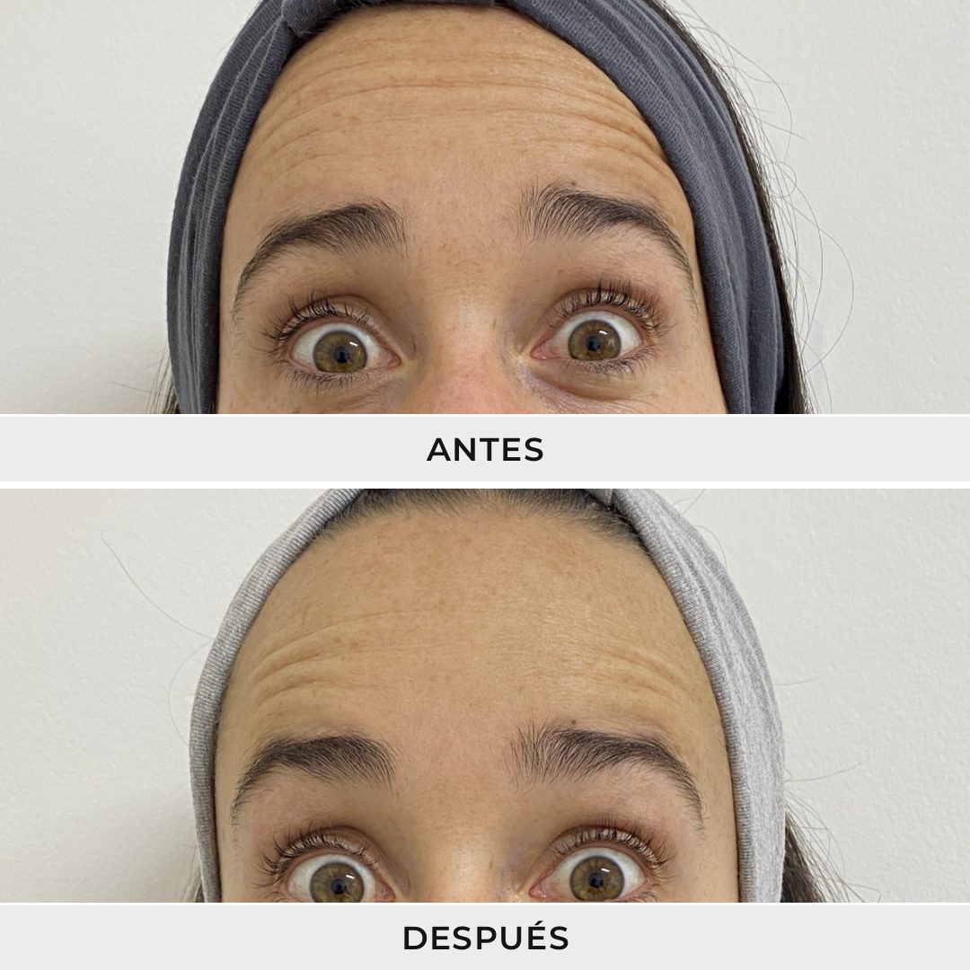 Aplicación de Neuromoduladores - Dra. Rolandi Ortíz - Ro Medical