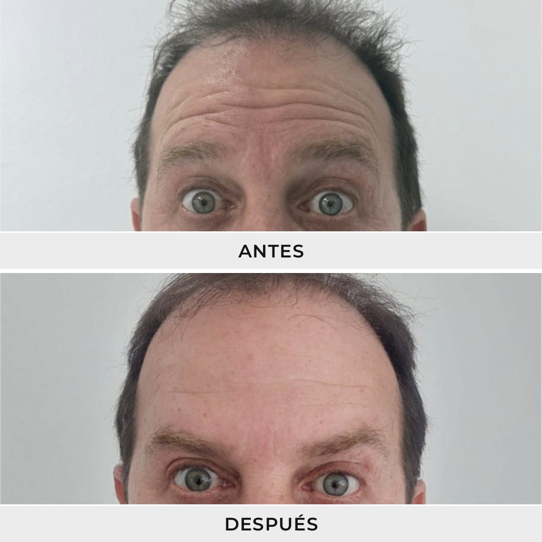 Aplicación de Neuromoduladores - Dra. Rolandi Ortíz - Ro Medical
