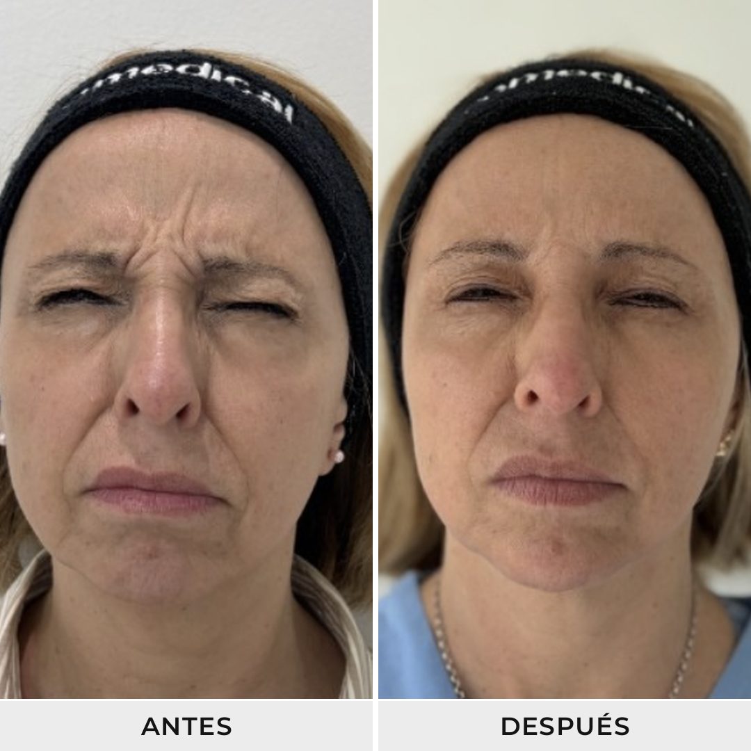 Aplicación de Neuromoduladores - Dra. Rolandi Ortíz - Ro Medical