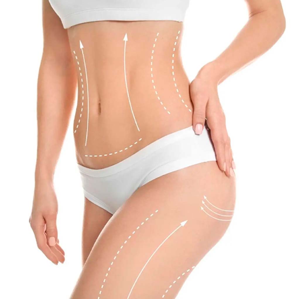 Bioestimulador de colágeno - Sculptra 1 ampolla