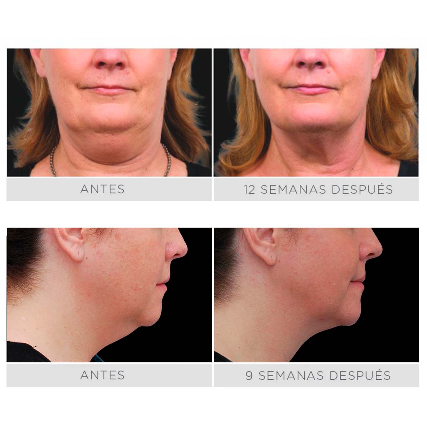 CoolSculpting - 1 Ciclo CoolMini