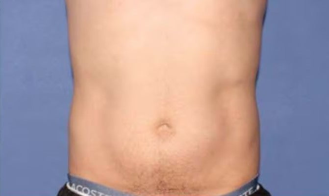 Después de CoolSculpting