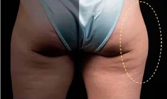 Antes de CoolSculpting