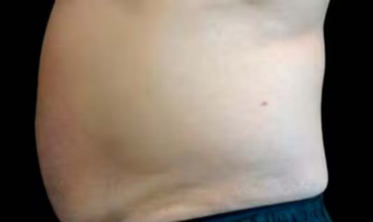 Antes de CoolSculpting