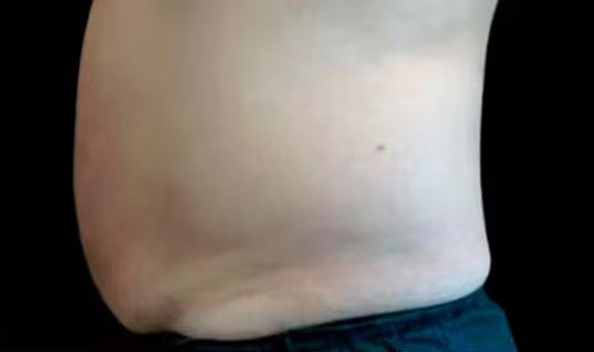 Después de CoolSculpting