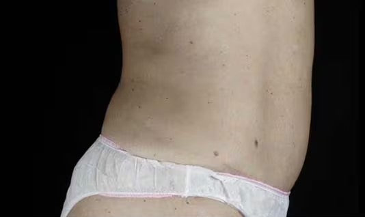 Antes de CoolSculpting