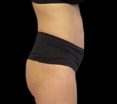 Antes de Emsculpt Neo