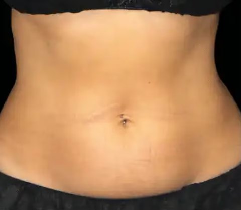 Antes de Emsculpt Neo
