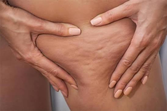 Piel con celulitis en el muslo
