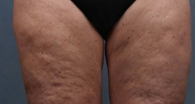 Antes de mesoterapia corporal