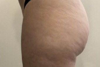 Antes de mesoterapia corporal
