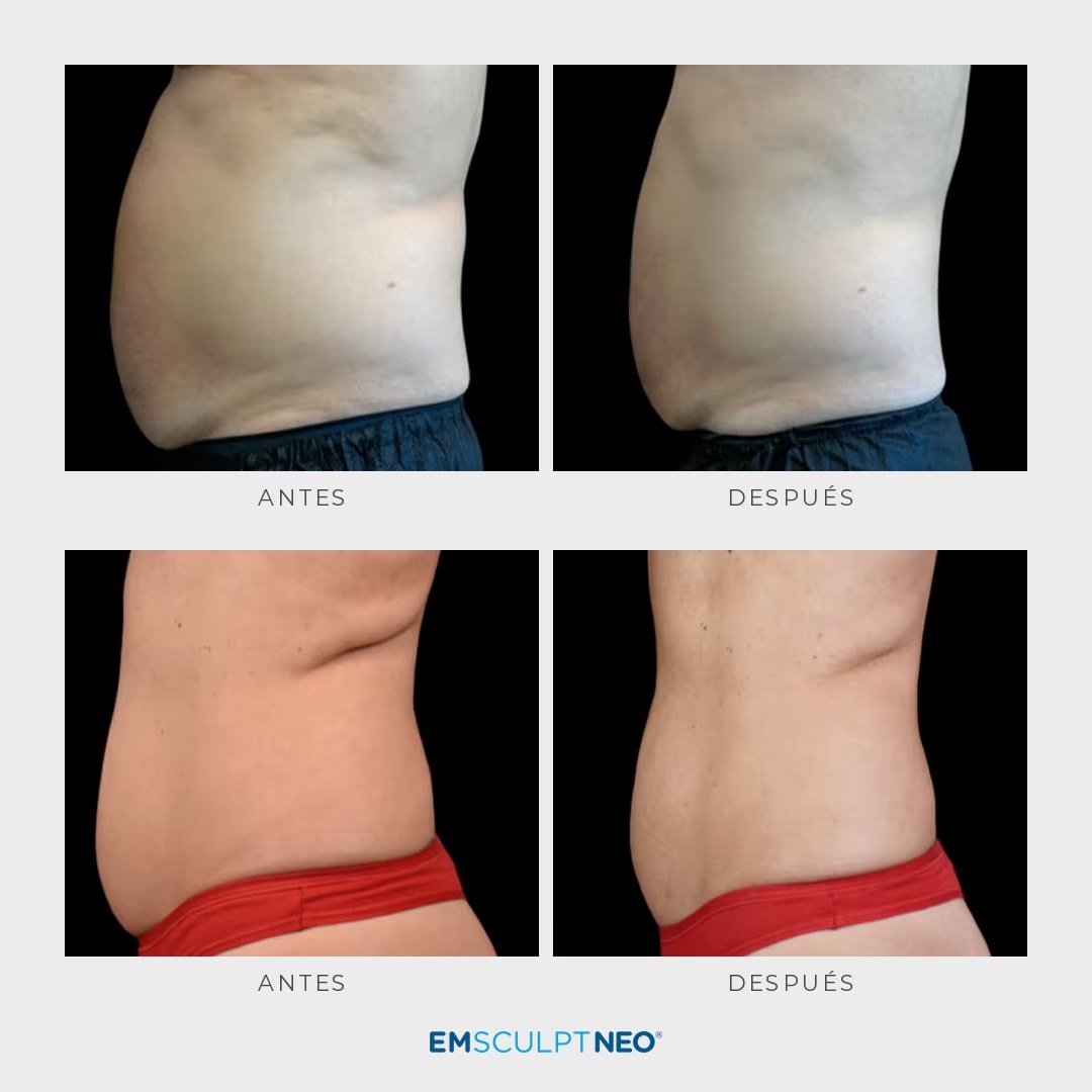 Emsculpt Neo - Pack 8 sesiones - Ro Medical