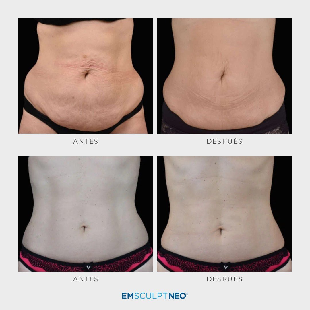 Emsculpt Neo - Pack 8 sesiones - Ro Medical